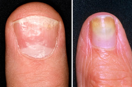 Грибковая инфекция ногтя