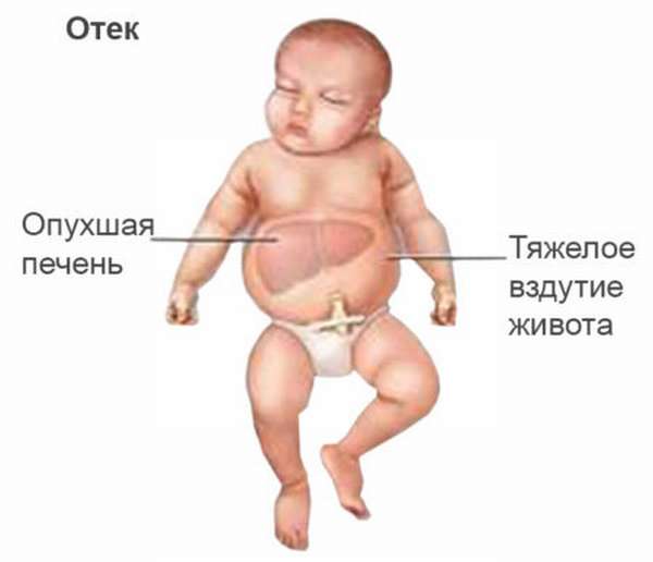 Насколько опасны конфликты по группе крови при беременности для матери и ребенка?