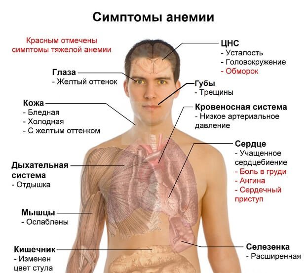 Симптомы анемии