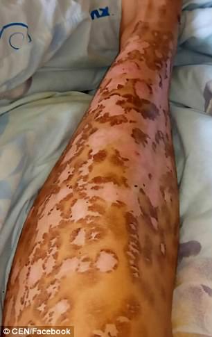 Burns: Photos capture the painful patches that Anastasia was left with after the session