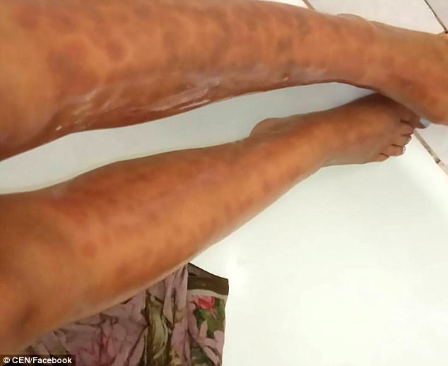 Lasting damage: Anastasia was warned she could have patches on her legs for six months
