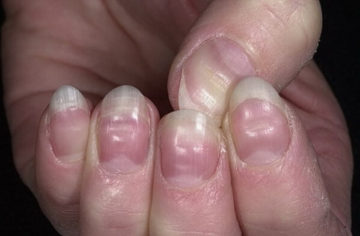 неровные ногти