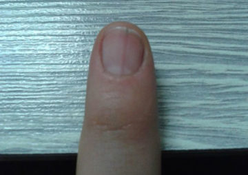 вертикальная трещина на ногте