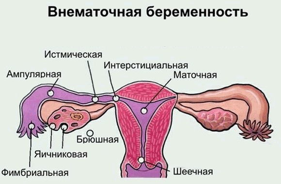 Тянет живот на ранних сроках беременности, как при месячных, до задержки, ноет в пояснице, с выделениями и без. Что делать?