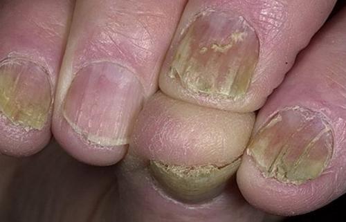 Ногти стали бугристые причины. Волнистые ногти на руках: как лечить в домашних условиях