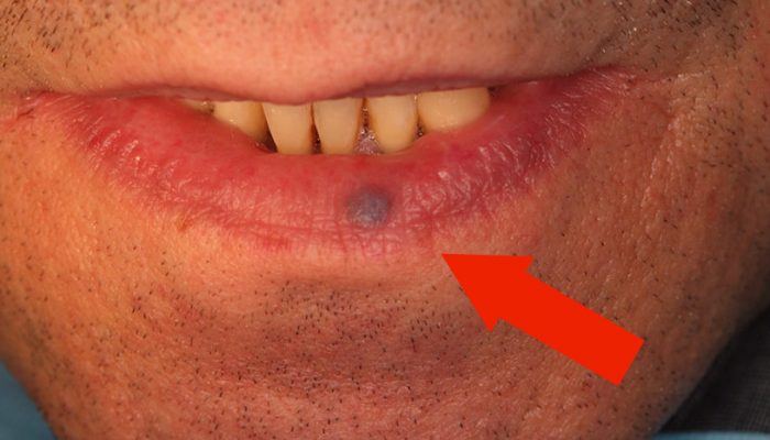 Что означает появление черного, синего или красного пятна на губе? Распространенные причины пигментации
