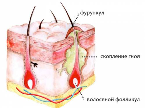 Образование фурункула