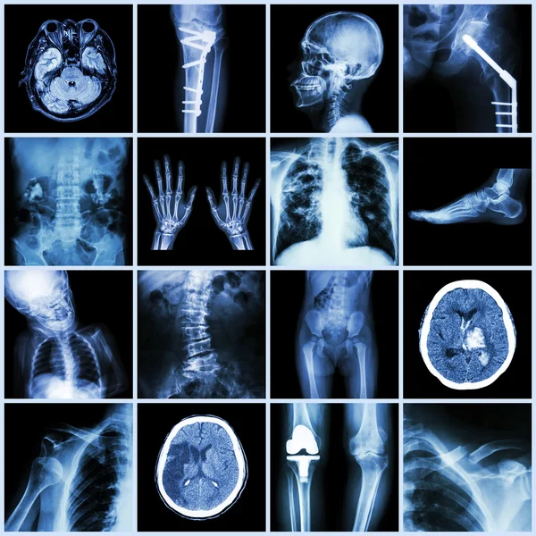 Set of X-ray multiple part of human,Multiple disease,orthopedic,surgery (Stroke,Bone fracture,Orthopedic operation,Kidney stone,Arthritis,Gout,Pulmonary tuberculosis,Heart disease,Scoliosis,etc) Stock Image