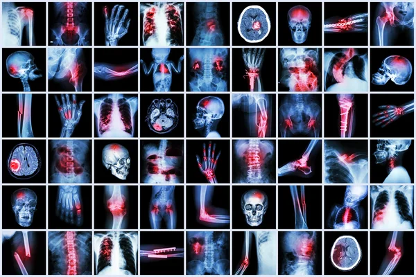 X-ray multiple disease of child and adult ( Stroke , Arthritis , Fracture , Tuberculosis , Brain tumor , Bowel obstruction  , Kidney stone , Spondylosis , Spondylolisthesis , Osteoarthritis knee ,etc) Royalty Free Stock Photos